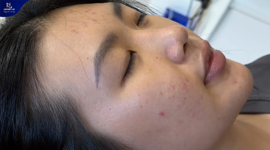 mụn trứng cá