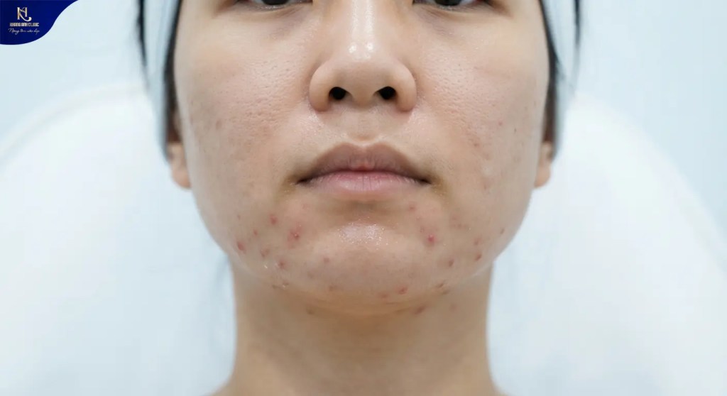 Cách điều trị mụn nội tiết