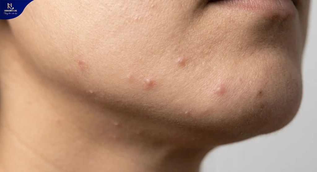 các loại mụn